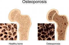 Glebe Hill Family Practice - Osteoporosis